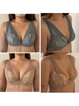 プレフィール(PLEAFEEL)/【バストアップ】症例☆たまプラ