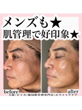 ホワイトアクア 天王寺本店(WHITE AQUA)/ララピール/大阪/天王寺/毛穴