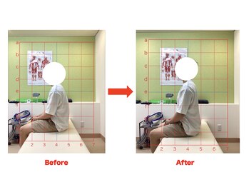 首肩ゆらり接骨院/30代男性/肩こり/肩甲骨はがし