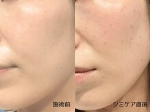 アンドアンド(&and)/【シミケア直後のお肌】