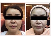 ヒフミ(hifumi.)/復元パック☆症例６