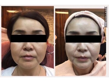 ヒフミ(hifumi.)/復元パック☆症例６