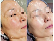 ビードット バイ ソーフライ(B.by So fly)/シミ.シワ.たるみ.毛穴を改善！
