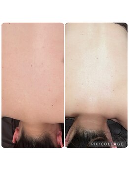 ラナン(ranan)/背中ケア