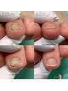 【変形爪】
