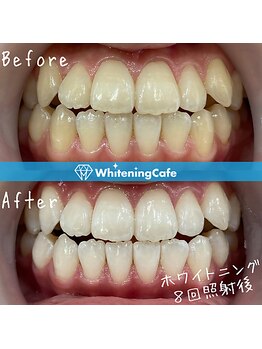 ホワイトニングカフェ 黒崎店(WhiteningCafe)/◎ホワイトニング症例写真◎