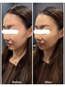 ※オープン記念【小顔】美容鍼+美顔マッサージ+美容パック13200円⇒8800円