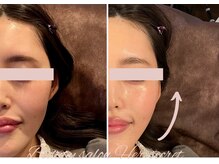 ハーシークレット(Her secret)/小顔マシーン＜小顔＞