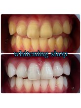 ホワイトニングショップ 福島店(WHITENINGSHOP)/フリーパス10回後のお客様