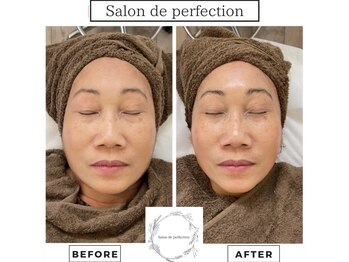 サロン ド パーフェクション(Salon de Perfection)/小顔リフト