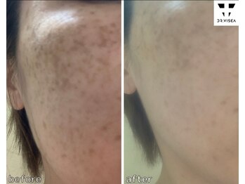 エスボーテ(sbeaute)/手強いシミケアでお悩みのお客様