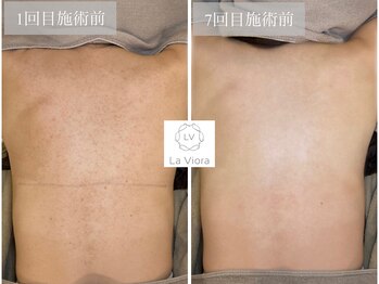 ラヴィオーラ 西宮北口店(La Viora)/ダイヤモンドハーブピーリング