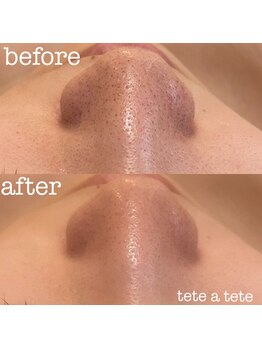 テテアテテ(tete a tete)/【毛穴洗浄】