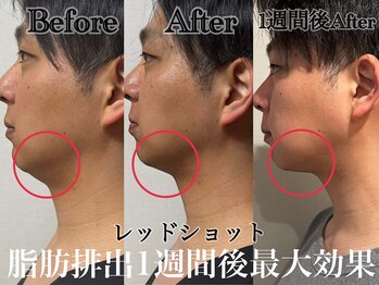 アンドエス 六本木(and S.)/レッドショットで理想の輪郭形成