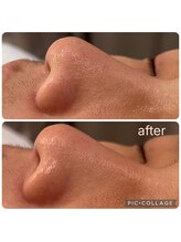 ラナン(ranan)/毛穴洗浄