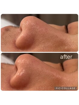 ラナン(ranan)/毛穴洗浄