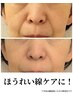 5/17まで!周年祭限定価格♪【ほうれい線ケア】シワたるみでお悩みの方へ