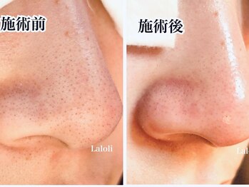 ラロリ(Laloli)/毛穴ケア