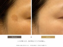 ルシェンテ 鈴鹿(Lucente)/ダクトピール経過　8回/40代女性