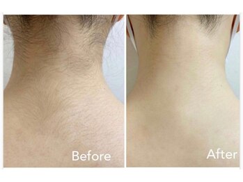 エアリアル 中津店/手の届かないうなじの毛