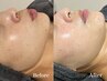 OPEN記念【顔～首】韓国女優肌・極！REVI陶器肌ハーブピーリング ¥13,200