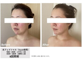 メイ(meiy)/たるみ/しわ/美白/毛穴