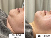 リコス(LICCO’S)/レモンボトル　６ミリ導入