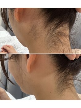 サロンドプレマージュ(Salon de Premage)/ブライダル前にうなじケア