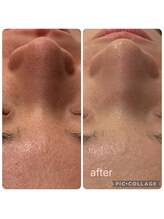 ラナン(ranan)/毛穴洗浄