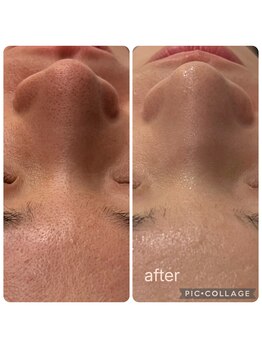 ラナン(ranan)/毛穴洗浄