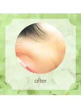 ビューティフィーサロン ベルル(Belulu)/えりあし脱毛 アフター