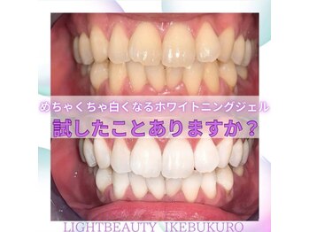 ライトビューティー 池袋店(LightBeauty)/症例写真