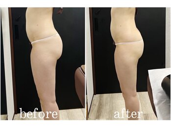 サロン ラズリ 久留米店(SALON Lazuli)/【1回施術】筋膜リリース痩身