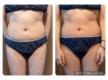 リリー(lily)/上半身痩身