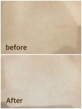 ヨシザワ インク 横浜みなとみらい桜木町店(YOSHIZAWA Inc.)/背中Before After