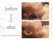 エステプリヴェモロッコ(ESTHE PRIVE MOROCCO)/フェイシャルカッサ＋デコルテ