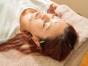 凛美鍼灸整骨マッサージ院の写真/≪ただの鍼の効果で終わらせない！≫有資格者のプロ視点でお悩み解決♪引き締めアップで小顔効果も◎♪