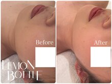 イデアルミー 大宮店(イデアルMe)/レモンボトル施術前・1週間後