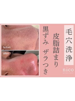 毛穴ケアをしたい