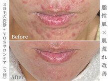 ゼアー(THERE FY.)/脱☆大人の肌トラブル