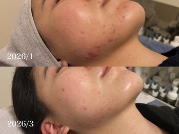 リリアス(RILLIAS)/ニキビケア/透き通る透明感