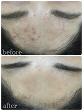 メイユール(MEILLEUR)/光フェイシャル6回