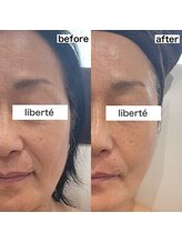 リベルテ 岡山(liberte)/カーボキシー炭酸パック
