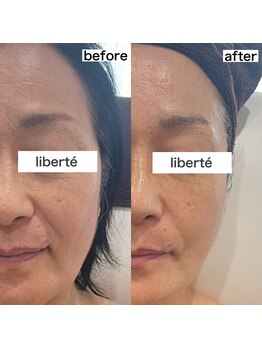 リベルテ 岡山(liberte)/カーボキシー炭酸パック