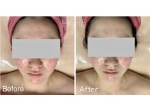 ハナ トータル ケア(Hana Total Care)/ベビースキン水玉リフティング