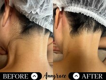 アングレイス(Anngrace)/【お顔脱毛うなじ】Before/After