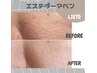 どんどん浅く【 毛穴撲滅!】最旬毛穴ケア!エステダーマ☆→初回¥10,000