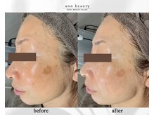 アン ビューティー(ann beauty)/施術1回【症例写真】