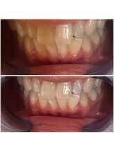 エクシアホワイトニング 代々木店/ホワイトニングビフォーアフター