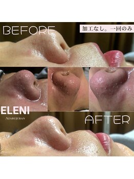 エレーニ 麻布十番(ELENI)/ハイドロピーリング・毛穴洗浄
